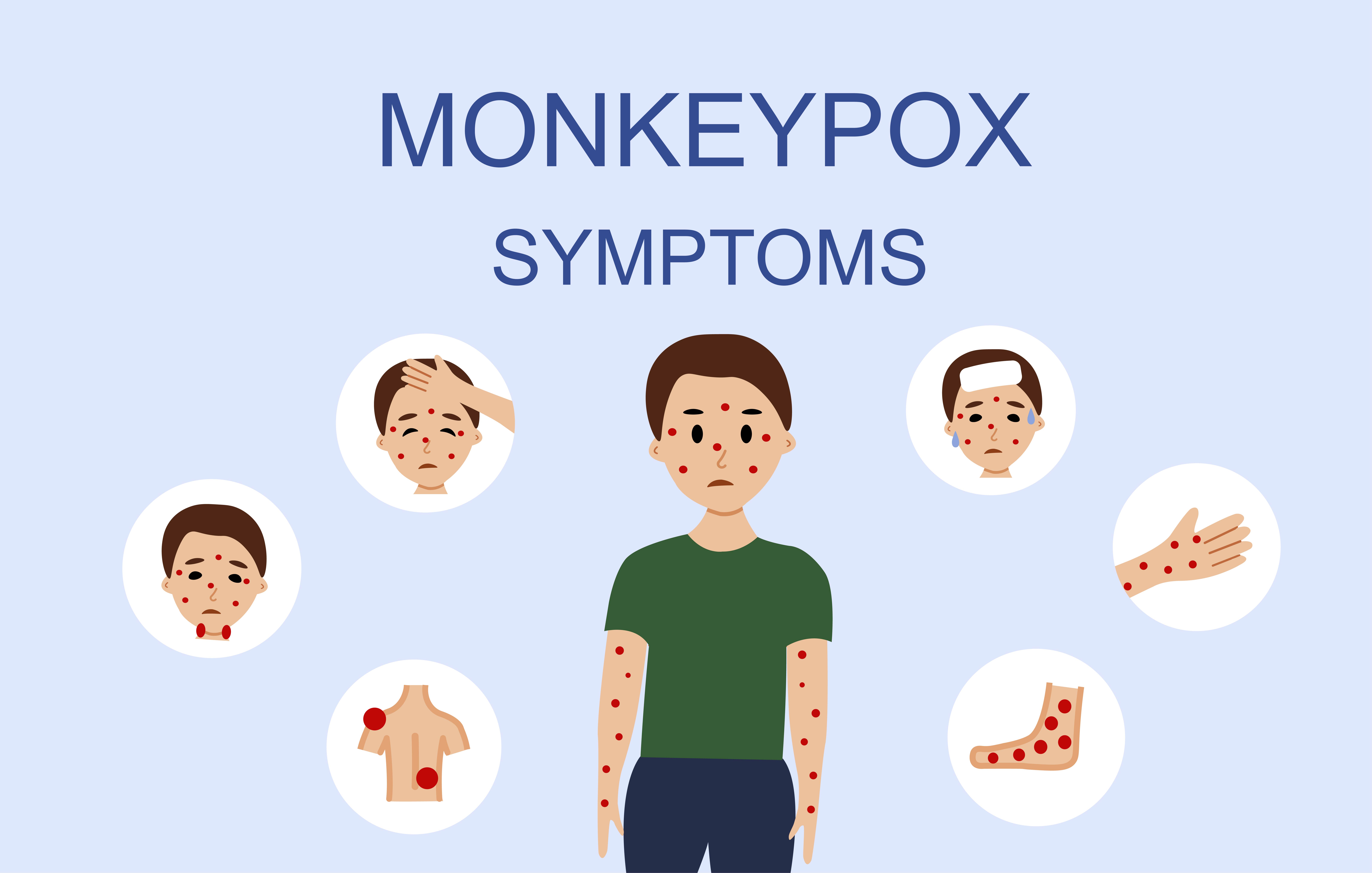 Mpox Symptoms, Risk Factors and Prevention